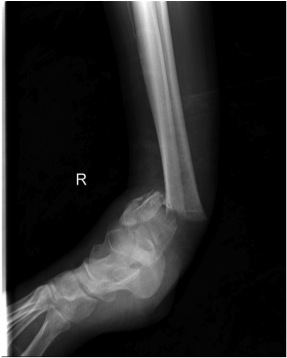 Distal Tibial Fracture Displaced